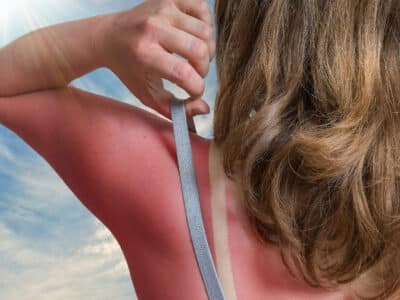 Sunburn Remedies