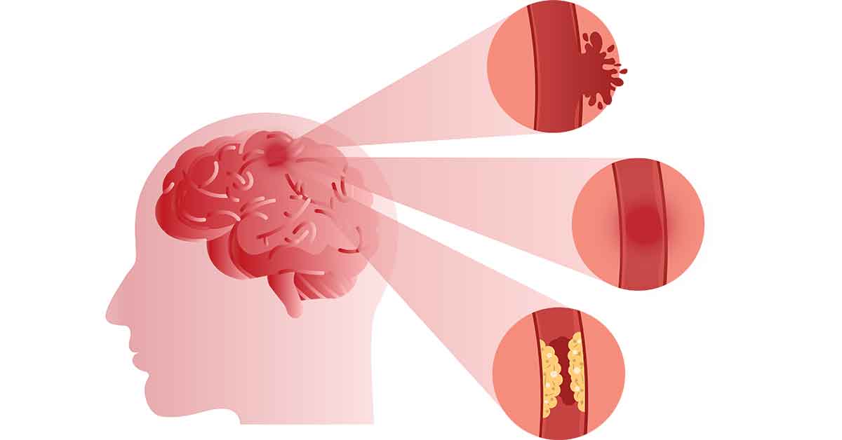 First Aid For Strokes