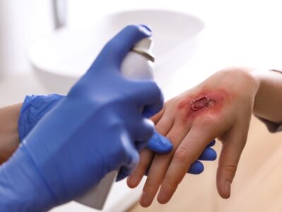 Second-Degree and Third-Degree Burns